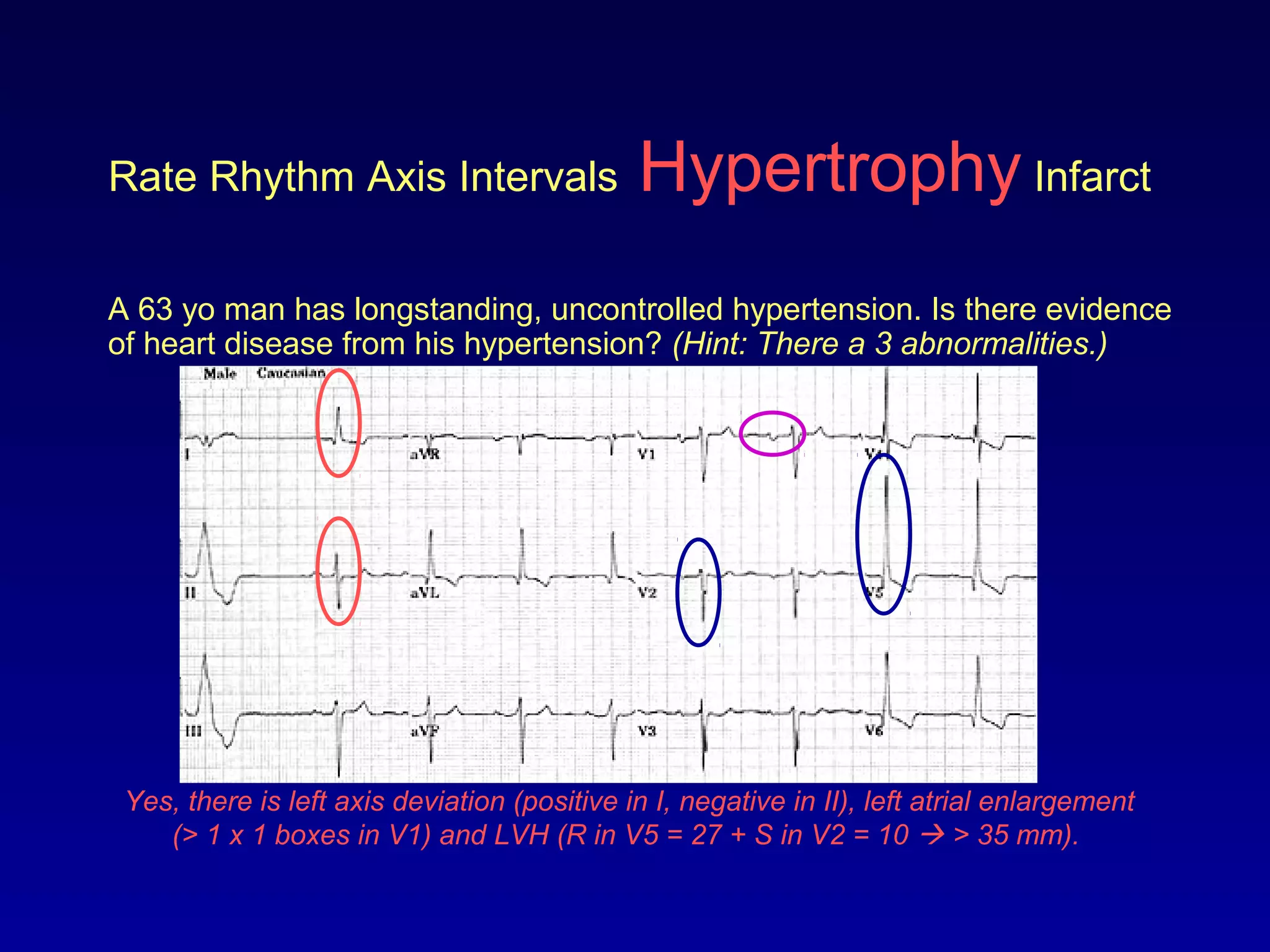 Rate Rhythm Axis Intervals Hypertrophy Infarct
A 63 yo man has longstanding, uncontrolled hypertension. Is there evidence
of heart disease from his hypertension? (Hint: There a 3 abnormalities.)
Yes, there is left axis deviation (positive in I, negative in II), left atrial enlargement
(> 1 x 1 boxes in V1) and LVH (R in V5 = 27 + S in V2 = 10  > 35 mm).
 