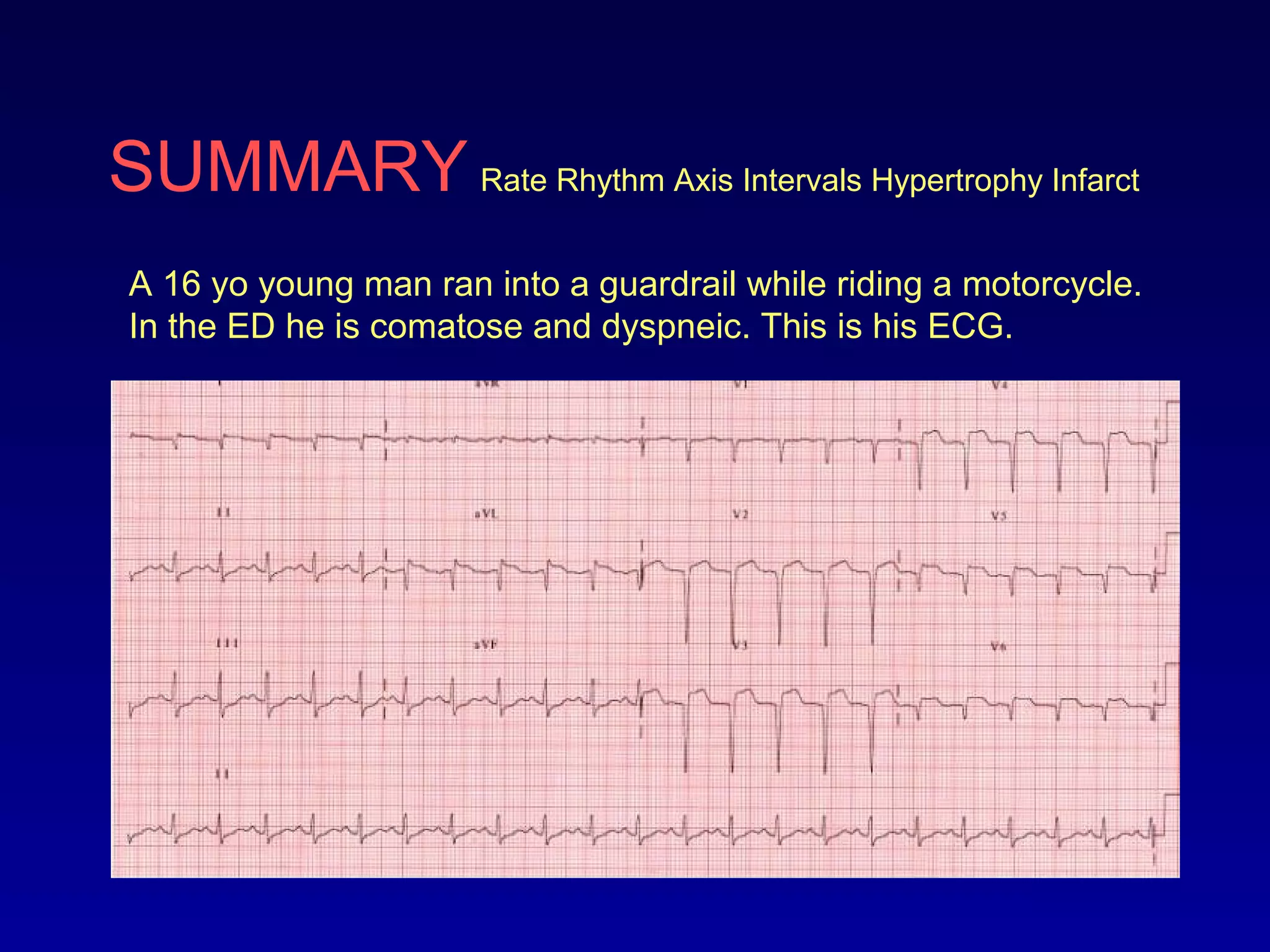 SUMMARY Rate Rhythm Axis Intervals Hypertrophy Infarct
A 16 yo young man ran into a guardrail while riding a motorcycle.
In the ED he is comatose and dyspneic. This is his ECG.
 