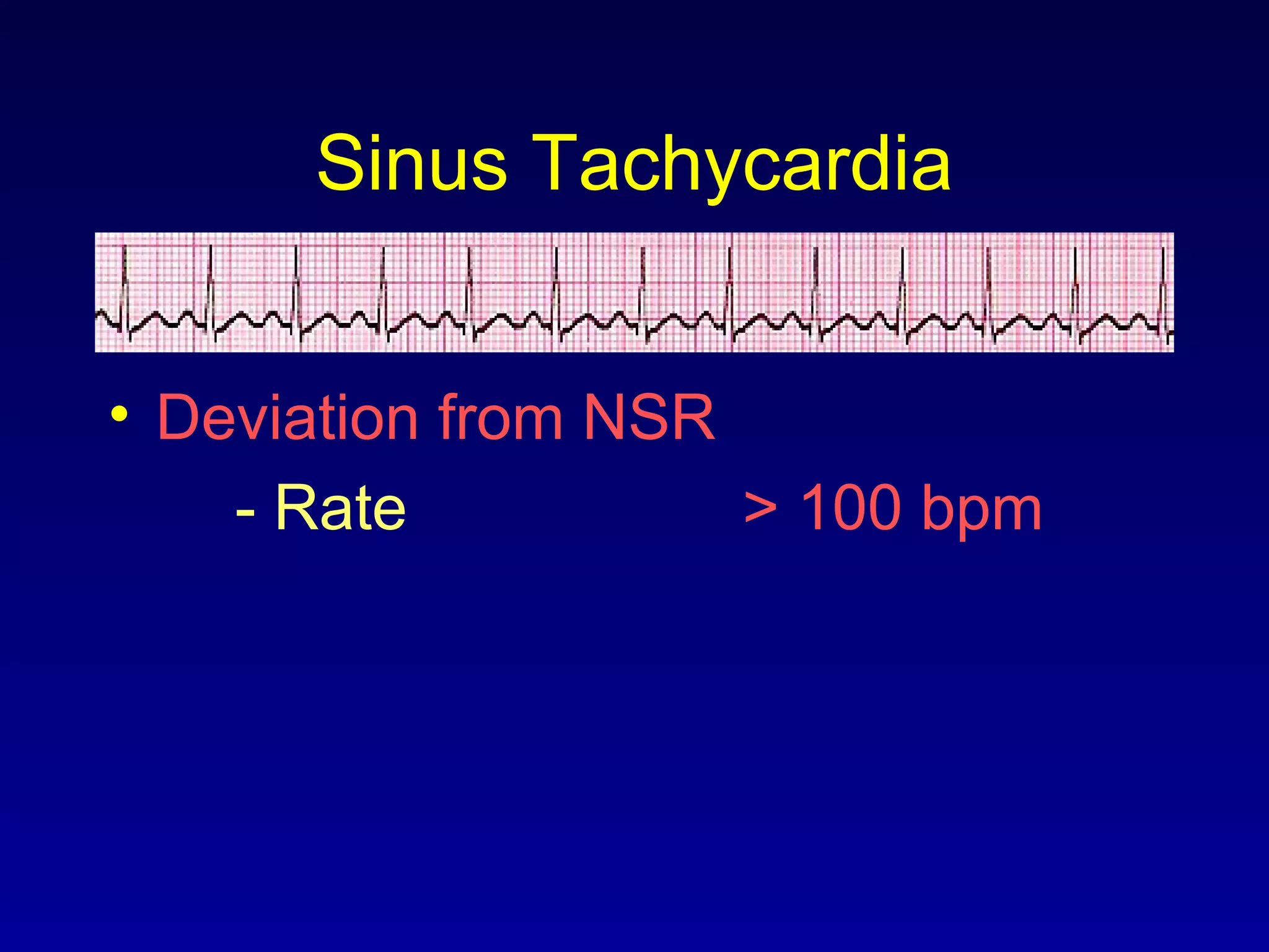 Sinus Tachycardia
• Deviation from NSR
- Rate > 100 bpm
 