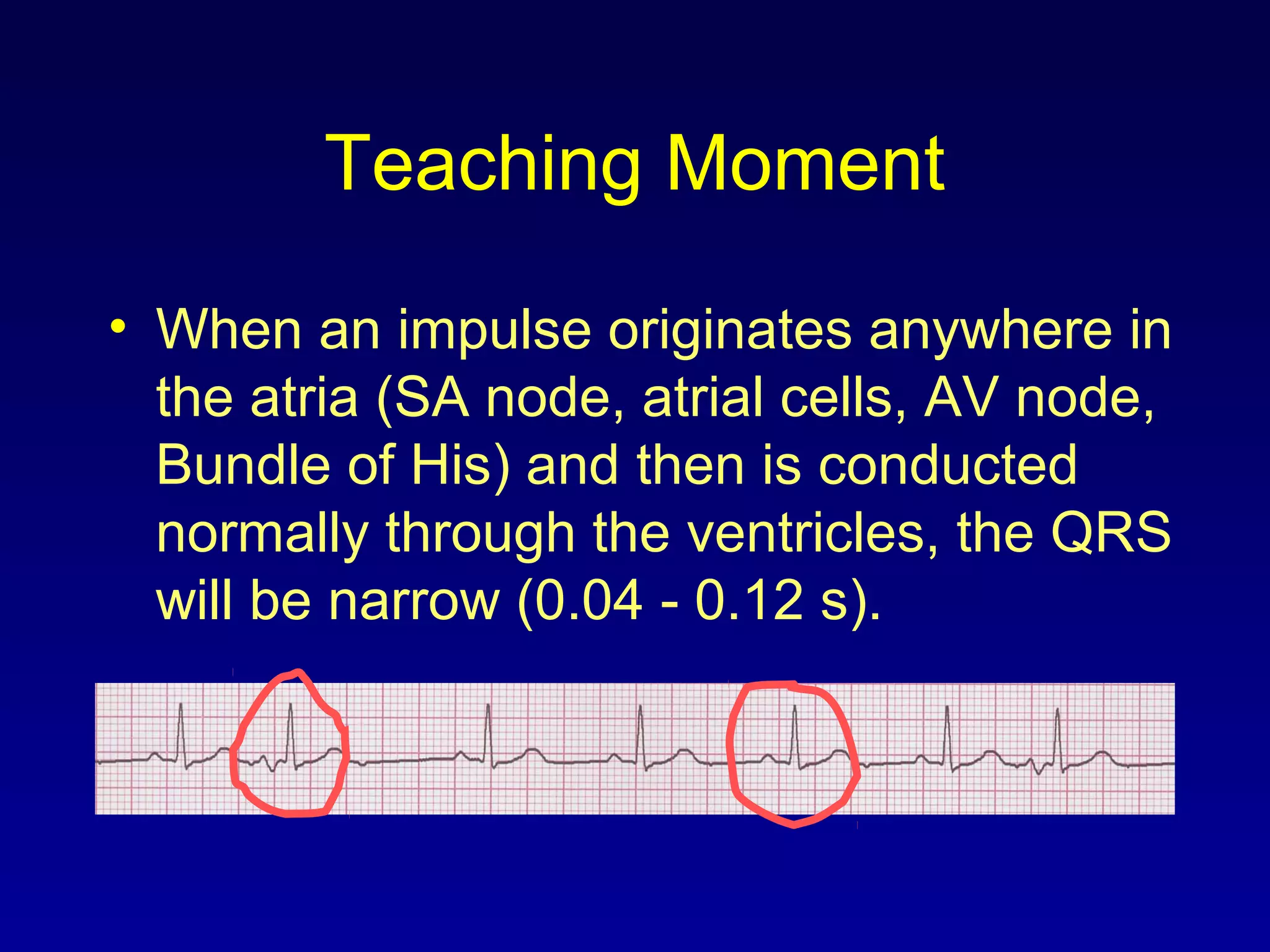 Teaching Moment
• When an impulse originates anywhere in
the atria (SA node, atrial cells, AV node,
Bundle of His) and then is conducted
normally through the ventricles, the QRS
will be narrow (0.04 - 0.12 s).
 