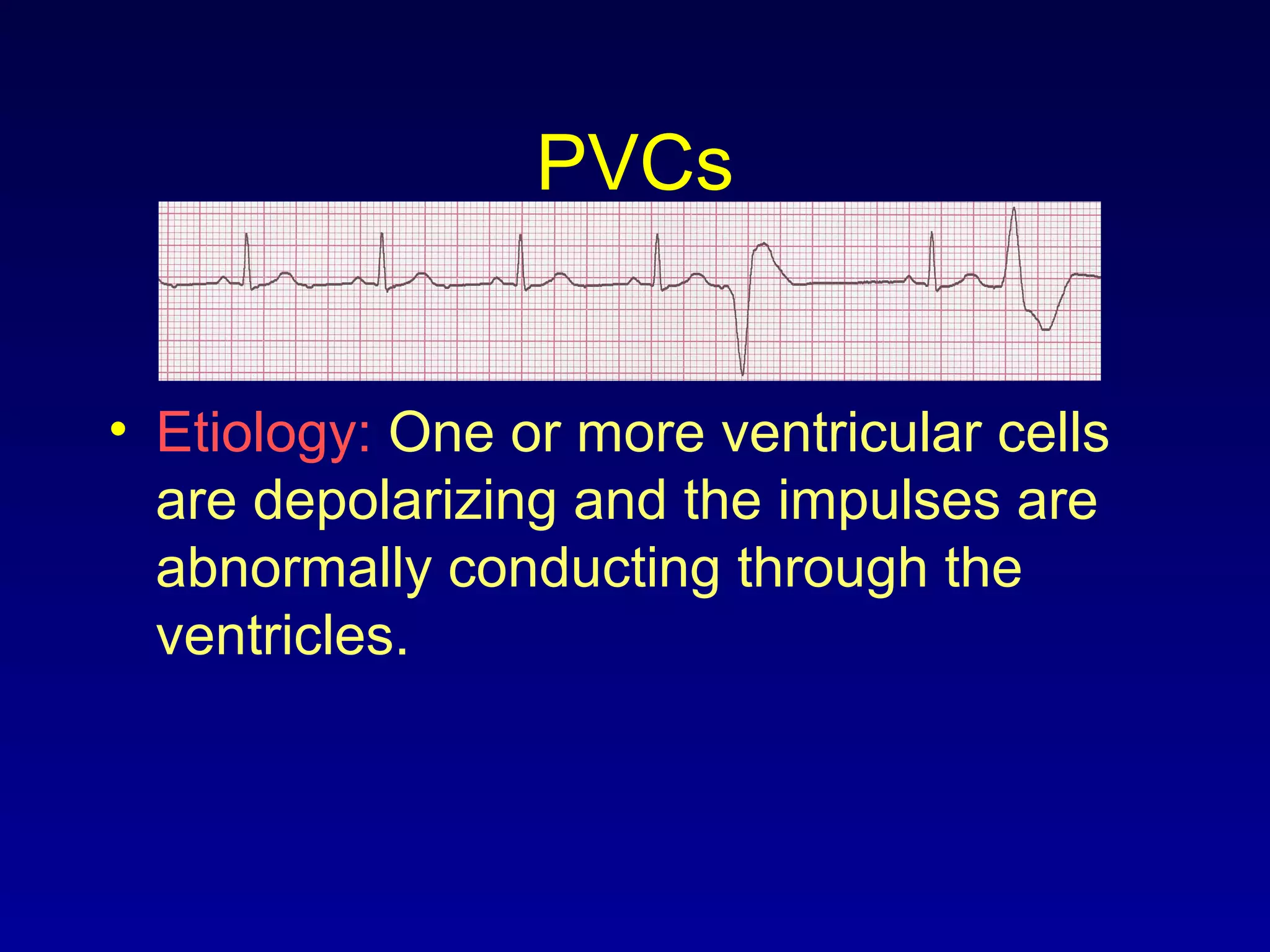 PVCs
• Etiology: One or more ventricular cells
are depolarizing and the impulses are
abnormally conducting through the
ventricles.
 