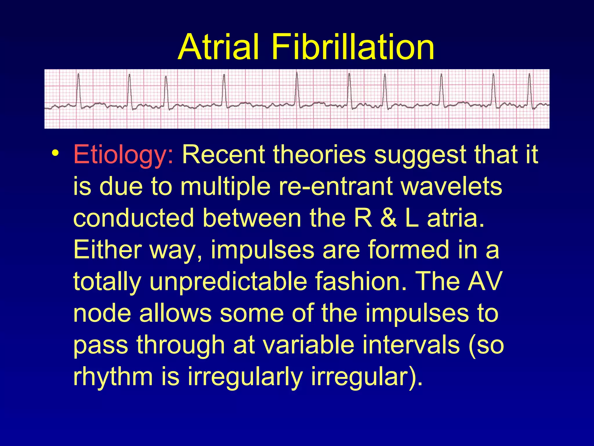 Atrial Fibrillation
• Etiology: Recent theories suggest that it
is due to multiple re-entrant wavelets
conducted between the R & L atria.
Either way, impulses are formed in a
totally unpredictable fashion. The AV
node allows some of the impulses to
pass through at variable intervals (so
rhythm is irregularly irregular).
 