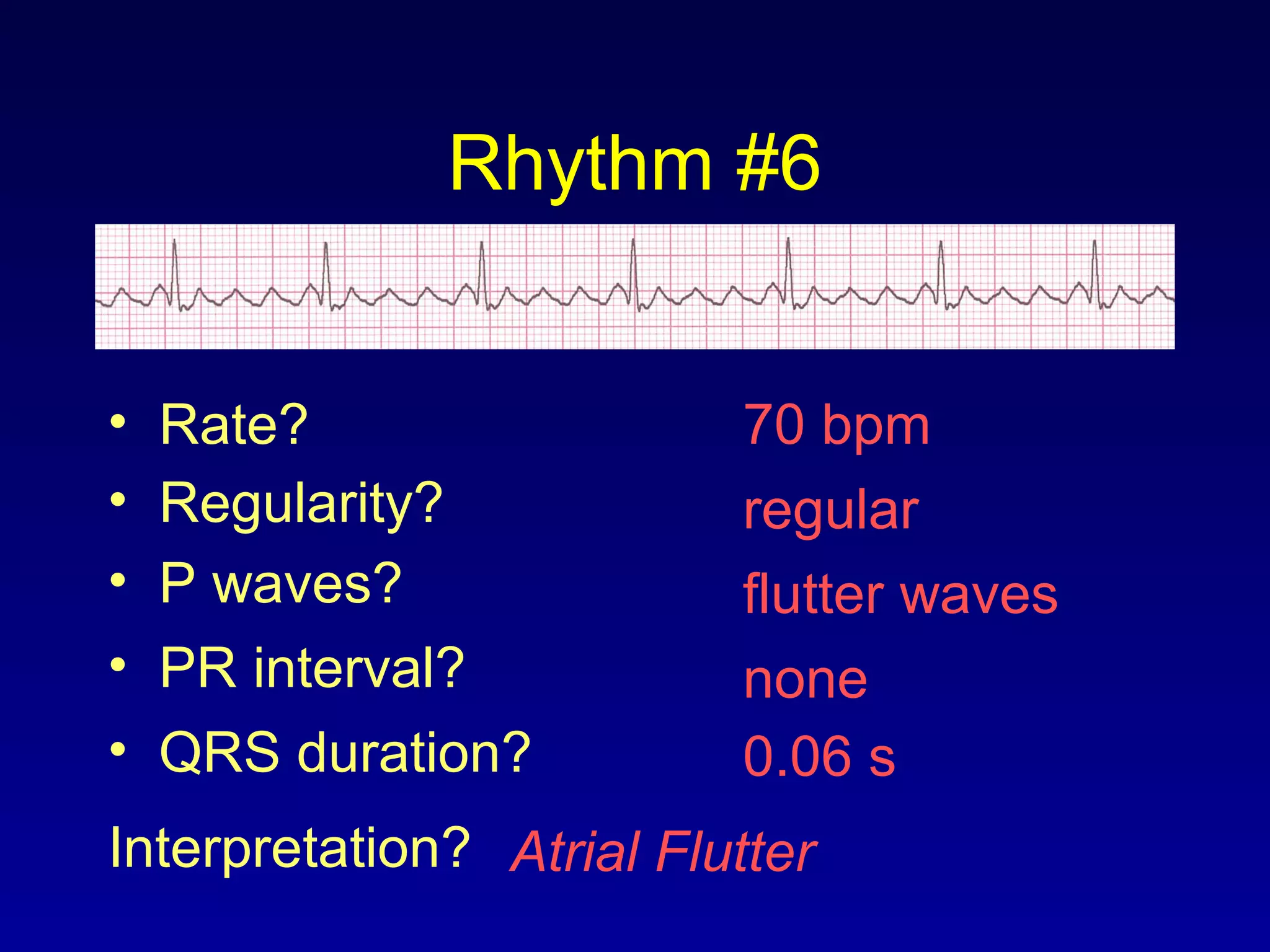 Rhythm #6
70 bpm• Rate?
• Regularity? regular
flutter waves
0.06 s
• P waves?
• PR interval? none
• QRS duration?
Interpretation? Atrial Flutter
 