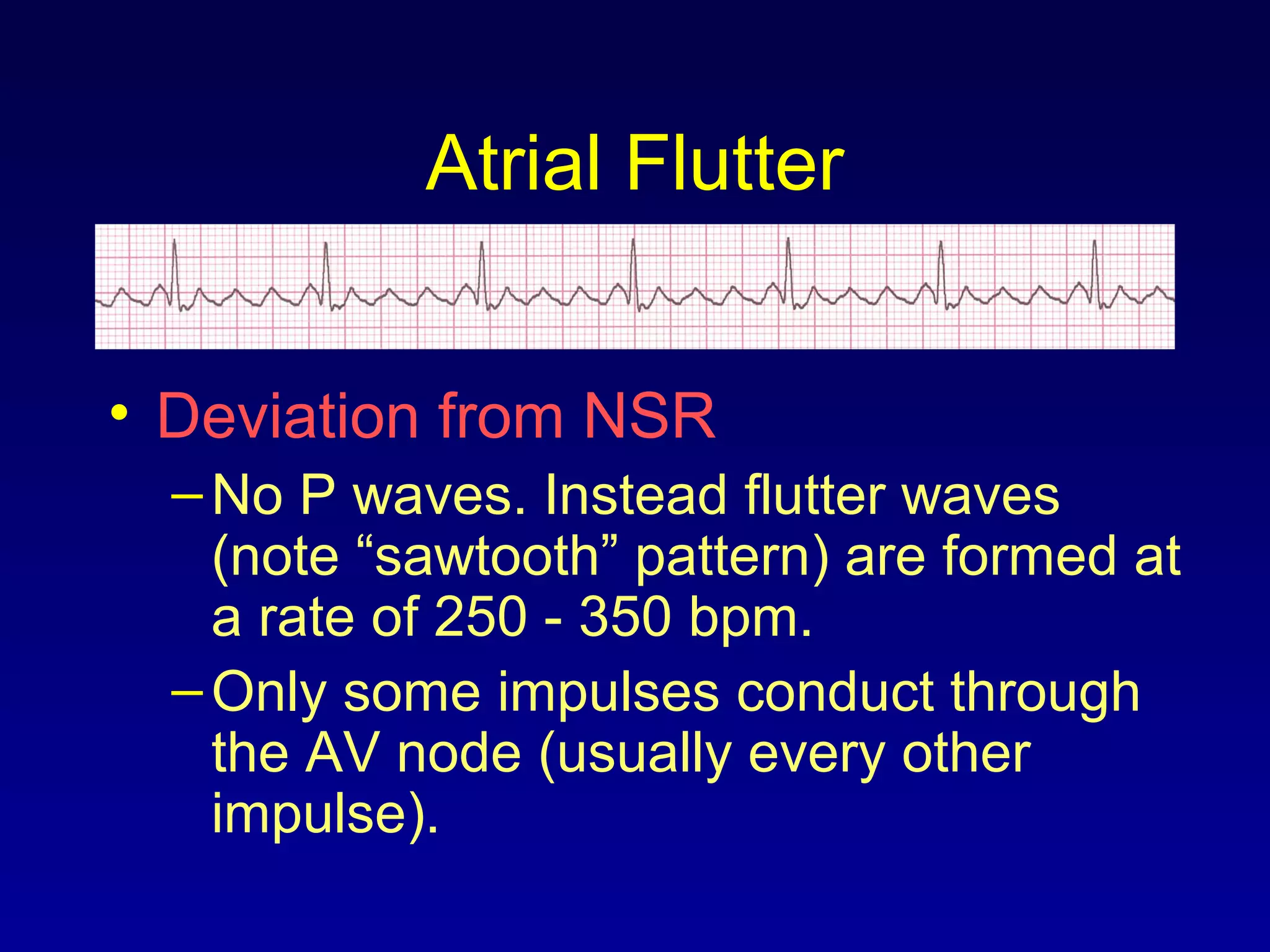 Atrial Flutter
• Deviation from NSR
–No P waves. Instead flutter waves
(note “sawtooth” pattern) are formed at
a rate of 250 - 350 bpm.
–Only some impulses conduct through
the AV node (usually every other
impulse).
 