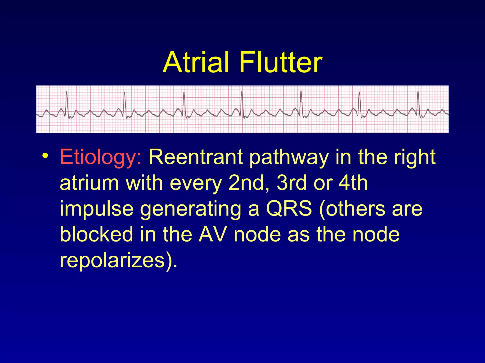 Atrial Flutter
• Etiology: Reentrant pathway in the right
atrium with every 2nd, 3rd or 4th
impulse generating a QRS (others are
blocked in the AV node as the node
repolarizes).
 