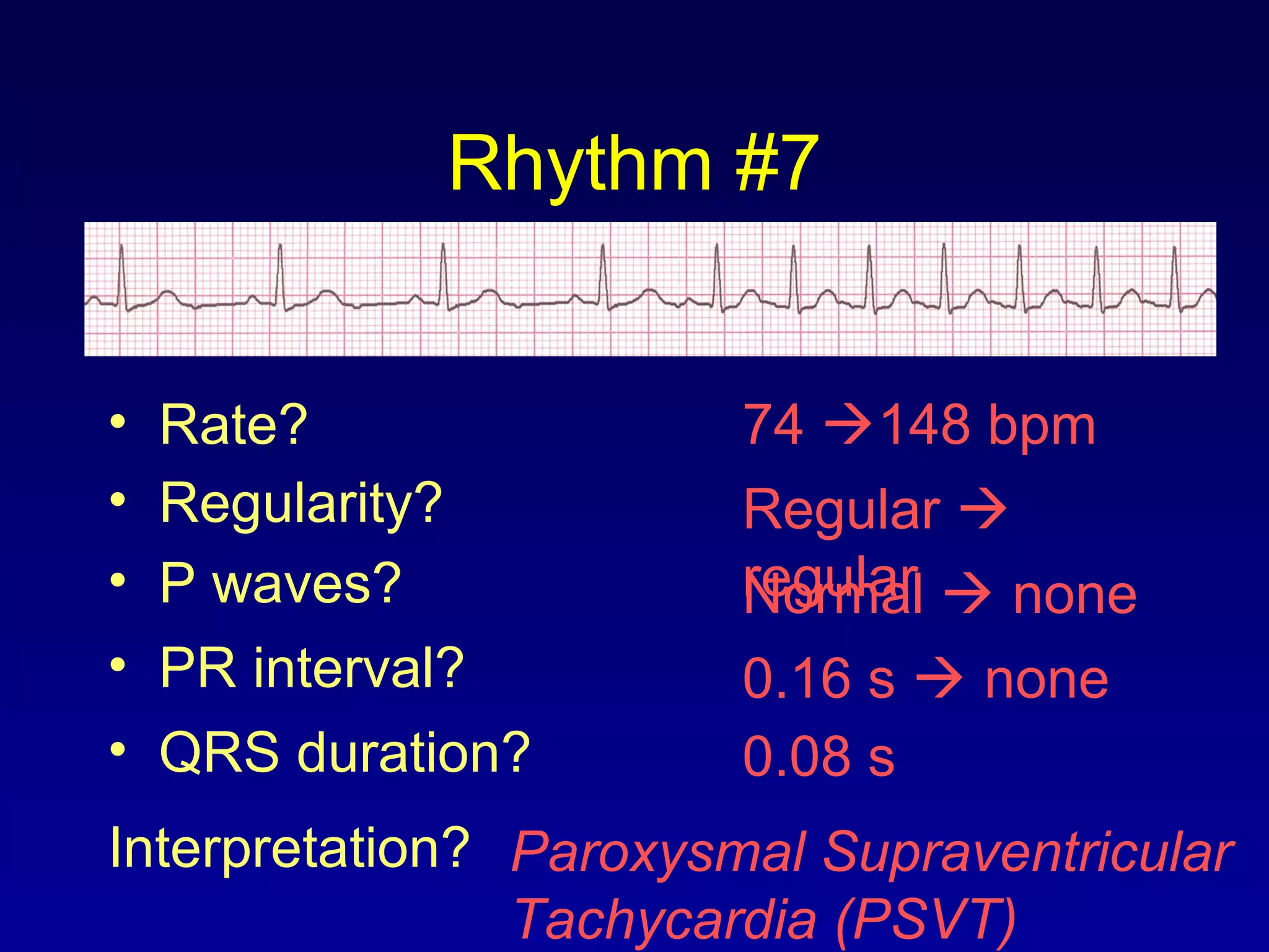 Rhythm #7
74 148 bpm• Rate?
• Regularity? Regular 
regularNormal  none
0.08 s
• P waves?
• PR interval? 0.16 s  none
• QRS duration?
Interpretation? Paroxysmal Supraventricular
Tachycardia (PSVT)
 