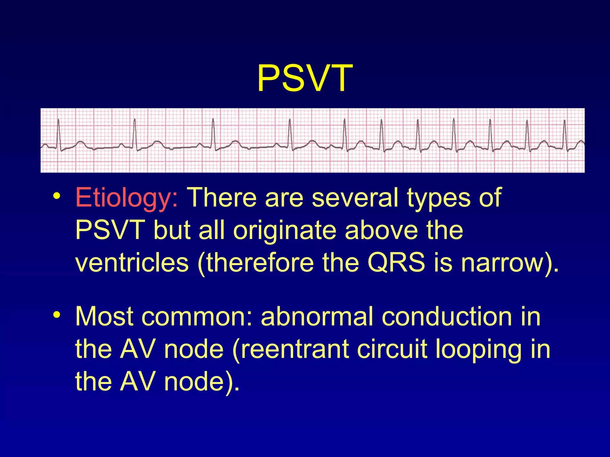 PSVT
• Etiology: There are several types of
PSVT but all originate above the
ventricles (therefore the QRS is narrow).
• Most common: abnormal conduction in
the AV node (reentrant circuit looping in
the AV node).
 