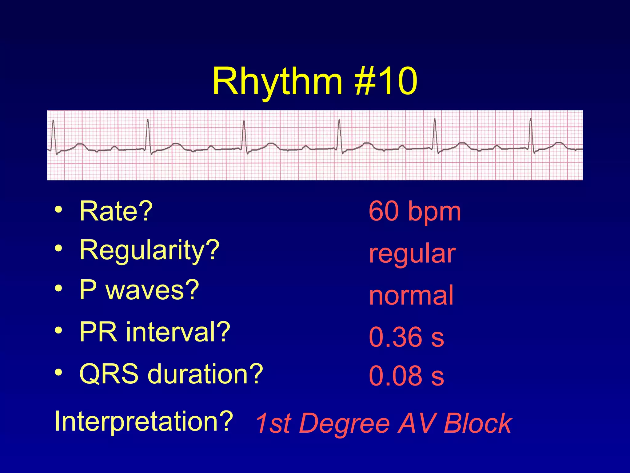 Rhythm #10
60 bpm• Rate?
• Regularity? regular
normal
0.08 s
• P waves?
• PR interval? 0.36 s
• QRS duration?
Interpretation? 1st Degree AV Block
 