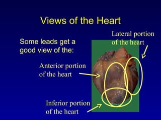 Views of the Heart
Some leads get a
good view of the:
Anterior portion
of the heart
Lateral portion
of the heart
Inferior portion
of the heart
 