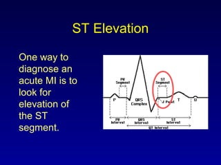 ST Elevation
One way to
diagnose an
acute MI is to
look for
elevation of
the ST
segment.
 