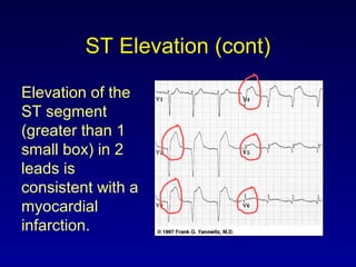 ST Elevation (cont)
Elevation of the
ST segment
(greater than 1
small box) in 2
leads is
consistent with a
myocardial
infarction.
 