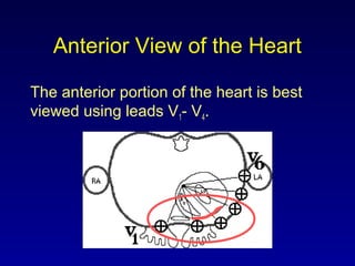Anterior View of the Heart
The anterior portion of the heart is best
viewed using leads V1- V4.
 