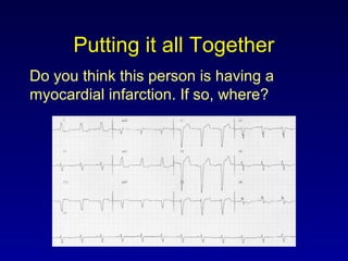 Putting it all Together
Do you think this person is having a
myocardial infarction. If so, where?
 