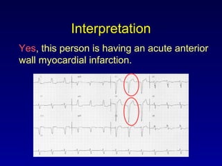 Interpretation
Yes, this person is having an acute anterior
wall myocardial infarction.
 