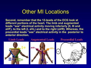 Other MI Locations
Second, remember that the 12-leads of the ECG look at
different portions of the heart. The limb and augmented
leads “see” electrical activity moving inferiorly (II, III and
aVF), to the left (I, aVL) and to the right (aVR). Whereas, the
precordial leads “see” electrical activity in the posterior to
anterior direction.
Limb Leads Augmented Leads Precordial Leads
 