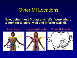 Other MI Locations
Now, using these 3 diagrams let’s figure where
to look for a lateral wall and inferior wall MI.
Limb Leads Augmented Leads Precordial Leads
 