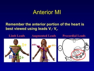 Anterior MI
Remember the anterior portion of the heart is
best viewed using leads V1- V4.
Limb Leads Augmented Leads Precordial Leads
 