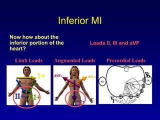 Inferior MI
Now how about the
inferior portion of the
heart?
Limb Leads Augmented Leads Precordial Leads
Leads II, III and aVF
 