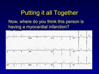 Putting it all Together
Now, where do you think this person is
having a myocardial infarction?
 