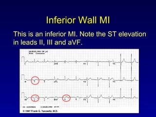 Inferior Wall MI
This is an inferior MI. Note the ST elevation
in leads II, III and aVF.
 