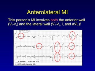 Anterolateral MI
This person’s MI involves both the anterior wall
(V2-V4) and the lateral wall (V5-V6, I, and aVL)!
 