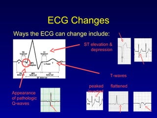 ECG Changes
Ways the ECG can change include:
Appearance
of pathologic
Q-waves
T-waves
peaked flattened
inverted
ST elevation &
depression
 