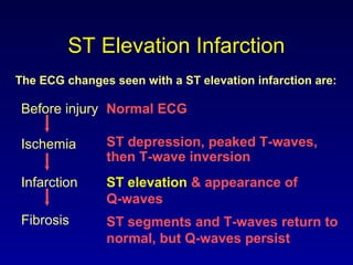 ST Elevation Infarction
ST depression, peaked T-waves,
then T-wave inversion
The ECG changes seen with a ST elevation infarction are:
Before injury Normal ECG
ST elevation & appearance of
Q-waves
ST segments and T-waves return to
normal, but Q-waves persist
Ischemia
Infarction
Fibrosis
 