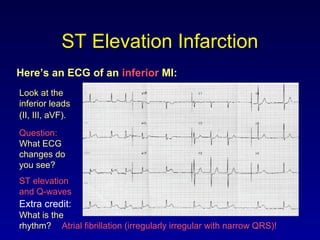 ST Elevation Infarction
Here’s an ECG of an inferior MI:
Look at the
inferior leads
(II, III, aVF).
Question:
What ECG
changes do
you see?
ST elevation
and Q-waves
Extra credit:
What is the
rhythm? Atrial fibrillation (irregularly irregular with narrow QRS)!
 