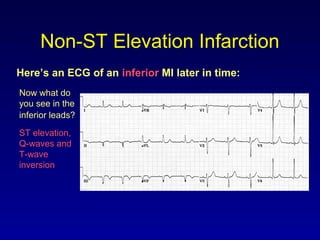 Non-ST Elevation Infarction
Here’s an ECG of an inferior MI later in time:
Now what do
you see in the
inferior leads?
ST elevation,
Q-waves and
T-wave
inversion
 