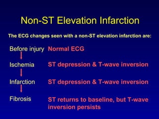 Non-ST Elevation Infarction
ST depression & T-wave inversion
The ECG changes seen with a non-ST elevation infarction are:
Before injury Normal ECG
ST depression & T-wave inversion
ST returns to baseline, but T-wave
inversion persists
Ischemia
Infarction
Fibrosis
 