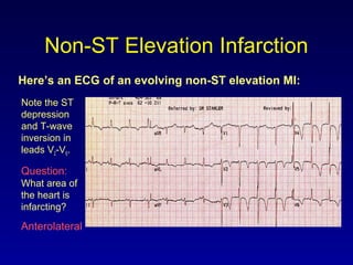 Non-ST Elevation Infarction
Here’s an ECG of an evolving non-ST elevation MI:
Note the ST
depression
and T-wave
inversion in
leads V2-V6.
Question:
What area of
the heart is
infarcting?
Anterolateral
 