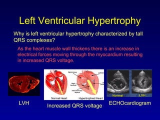 Left Ventricular Hypertrophy
Why is left ventricular hypertrophy characterized by tall
QRS complexes?
LVH ECHOcardiogram
Increased QRS voltage
As the heart muscle wall thickens there is an increase in
electrical forces moving through the myocardium resulting
in increased QRS voltage.
 