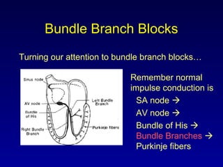 Bundle Branch Blocks
Turning our attention to bundle branch blocks…
Remember normal
impulse conduction is
SA node 
AV node 
Bundle of His 
Bundle Branches 
Purkinje fibers
 