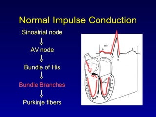 Normal Impulse Conduction
Sinoatrial node
AV node
Bundle of His
Bundle Branches
Purkinje fibers
 
