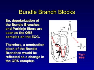 Bundle Branch Blocks
So, depolarization of
the Bundle Branches
and Purkinje fibers are
seen as the QRS
complex on the ECG.
Therefore, a conduction
block of the Bundle
Branches would be
reflected as a change in
the QRS complex.
Right
BBB
 