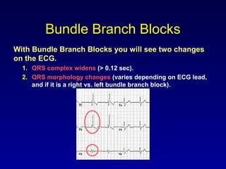 Bundle Branch Blocks
With Bundle Branch Blocks you will see two changes
on the ECG.
1. QRS complex widens (> 0.12 sec).
2. QRS morphology changes (varies depending on ECG lead,
and if it is a right vs. left bundle branch block).
 