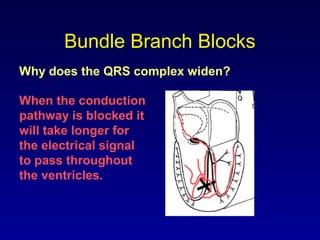 Bundle Branch Blocks
Why does the QRS complex widen?
When the conduction
pathway is blocked it
will take longer for
the electrical signal
to pass throughout
the ventricles.
 