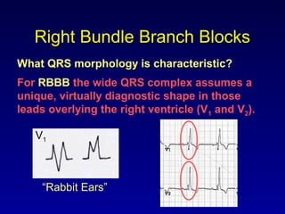Right Bundle Branch Blocks
What QRS morphology is characteristic?
V1
For RBBB the wide QRS complex assumes a
unique, virtually diagnostic shape in those
leads overlying the right ventricle (V1 and V2).
“Rabbit Ears”
 