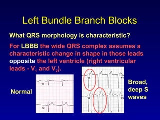 Left Bundle Branch Blocks
What QRS morphology is characteristic?
For LBBB the wide QRS complex assumes a
characteristic change in shape in those leads
opposite the left ventricle (right ventricular
leads - V1 and V2).
Broad,
deep S
waves
Normal
 