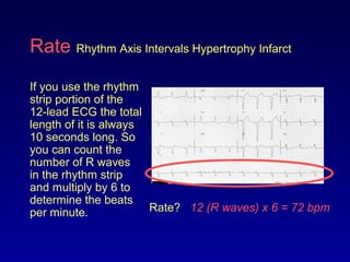 Rate Rhythm Axis Intervals Hypertrophy Infarct
If you use the rhythm
strip portion of the
12-lead ECG the total
length of it is always
10 seconds long. So
you can count the
number of R waves
in the rhythm strip
and multiply by 6 to
determine the beats
per minute. Rate? 12 (R waves) x 6 = 72 bpm
 