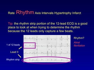 Rate Rhythm Axis Intervals Hypertrophy Infarct
Tip: the rhythm strip portion of the 12-lead ECG is a good
place to look at when trying to determine the rhythm
because the 12 leads only capture a few beats.
Lead II
Rhythm?
Atrial
fibrillation
Rhythm strip
1 of 12 leads
 
