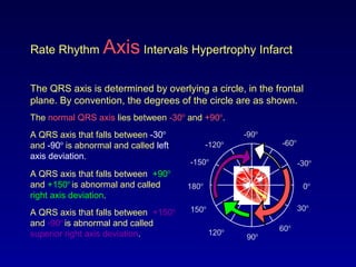 Rate Rhythm Axis Intervals Hypertrophy Infarct
The QRS axis is determined by overlying a circle, in the frontal
plane. By convention, the degrees of the circle are as shown.
The normal QRS axis lies between -30o
and +90o
.
0o
30o
-30o
60o
-60o
-90o
-120o
90o120o
150o
180o
-150o
A QRS axis that falls between -30o
and -90o
is abnormal and called left
axis deviation.
A QRS axis that falls between +90o
and +150o
is abnormal and called
right axis deviation.
A QRS axis that falls between +150o
and -90o
is abnormal and called
superior right axis deviation.
 