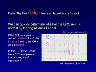 Rate Rhythm Axis Intervals Hypertrophy Infarct
We can quickly determine whether the QRS axis is
normal by looking at leads I and II.
If the QRS complex is
overall positive (R > Q+S)
in leads I and II, the QRS
axis is normal.
QRS negative (R < Q+S)
In this ECG what leads
have QRS complexes
that are negative?
equivocal?
QRS equivocal (R = Q+S)
 