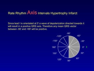 0o
30o
-30o
60o
-60o
-90o
-120o
90o120o
150o
180o
-150o
Rate Rhythm Axis Intervals Hypertrophy Infarct
Since lead I is orientated at 0o
a wave of depolarization directed towards it
will result in a positive QRS axis. Therefore any mean QRS vector
between -90o
and +90o
will be positive.
I
 