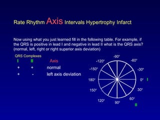 0o
30o
-30o
60o
-60o
-90o
-120o
90o120o
150o
180o
-150o
0o
30o
-30o
60o
-60o
-90o
-120o
90o120o
150o
180o
-150o
Rate Rhythm Axis Intervals Hypertrophy Infarct
Now using what you just learned fill in the following table. For example, if
the QRS is positive in lead I and negative in lead II what is the QRS axis?
(normal, left, right or right superior axis deviation)
QRS Complexes
I
AxisI II
+ +
+ -
normal
left axis deviation
II
 