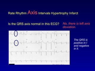 Rate Rhythm Axis Intervals Hypertrophy Infarct
Is the QRS axis normal in this ECG? No, there is left axis
deviation.
The QRS is
positive in I
and negative
in II.
 