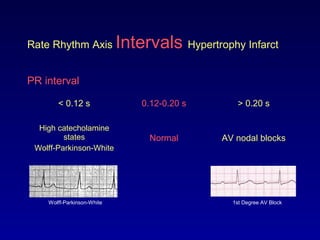 Rate Rhythm Axis Intervals Hypertrophy Infarct
PR interval
< 0.12 s 0.12-0.20 s > 0.20 s
High catecholamine
states
Wolff-Parkinson-White
Normal AV nodal blocks
Wolff-Parkinson-White 1st Degree AV Block
 