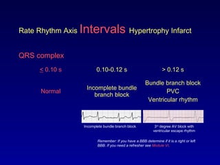 Rate Rhythm Axis Intervals Hypertrophy Infarct
QRS complex
< 0.10 s 0.10-0.12 s > 0.12 s
Normal
Incomplete bundle
branch block
Bundle branch block
PVC
Ventricular rhythm
Remember: If you have a BBB determine if it is a right or left
BBB. If you need a refresher see Module VI.
3rd
degree AV block with
ventricular escape rhythm
Incomplete bundle branch block
 