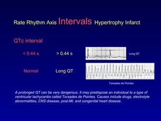 Rate Rhythm Axis Intervals Hypertrophy Infarct
QTc interval
< 0.44 s > 0.44 s
Normal Long QT
A prolonged QT can be very dangerous. It may predispose an individual to a type of
ventricular tachycardia called Torsades de Pointes. Causes include drugs, electrolyte
abnormalities, CNS disease, post-MI, and congenital heart disease.
Torsades de Pointes
Long QT
 