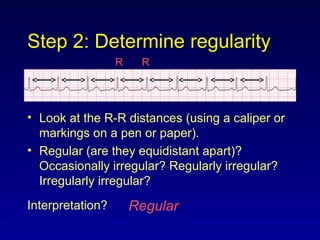 Step 2: Determine regularity
• Look at the R-R distances (using a caliper or
markings on a pen or paper).
• Regular (are they equidistant apart)?
Occasionally irregular? Regularly irregular?
Irregularly irregular?
Interpretation? Regular
R R
 